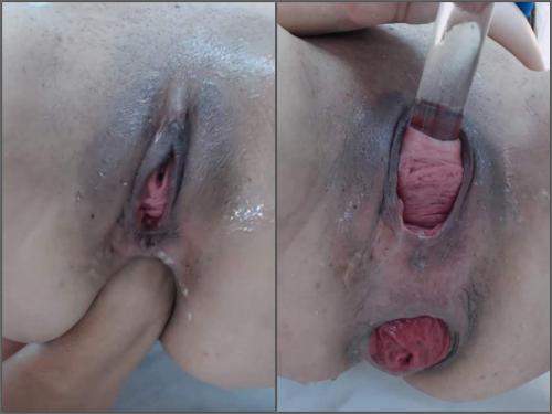 Prolapse ass – Webcam latina Carolinauribe cervix stretching and loose prolapse anal hardcore