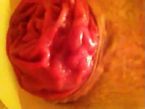 Rosebutt – Really amateur closeup monster size prolapse anal