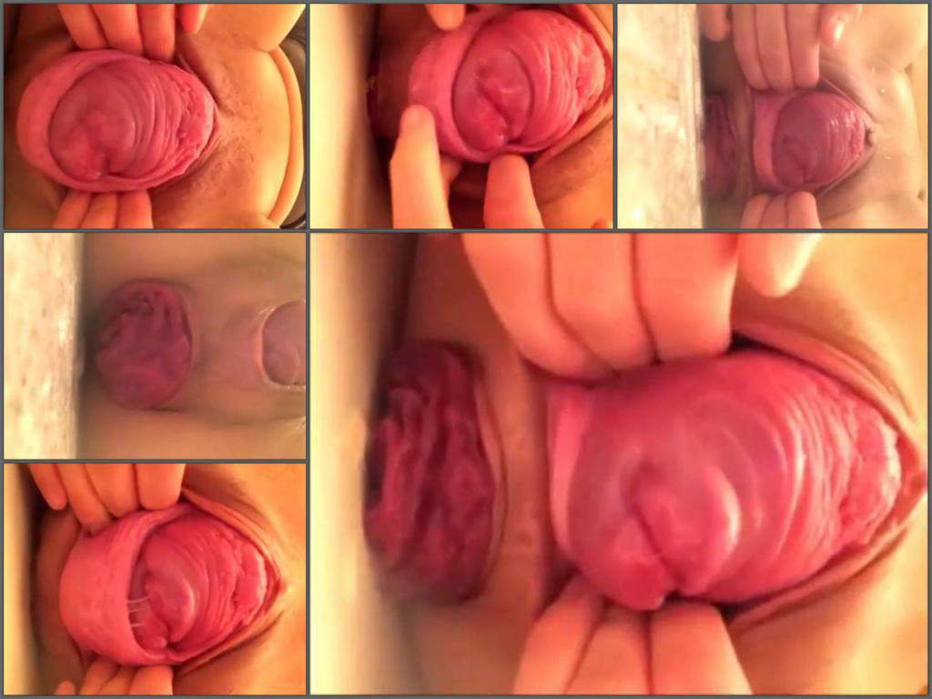 Prolapse porn cervix Cervix Prolapse