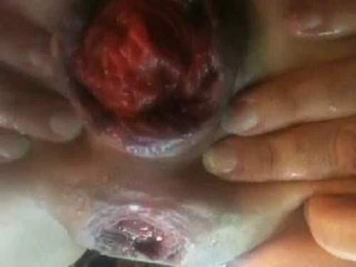 Anal prolapse – Incredible homemade very closeup huge prolapse anal penetrate