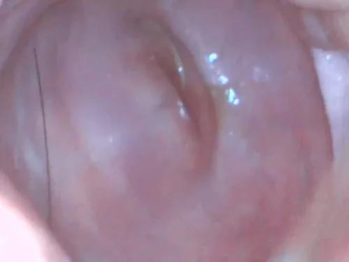 Urethral sounding – Russian girl Moon Christine Cervix close up with endoscope